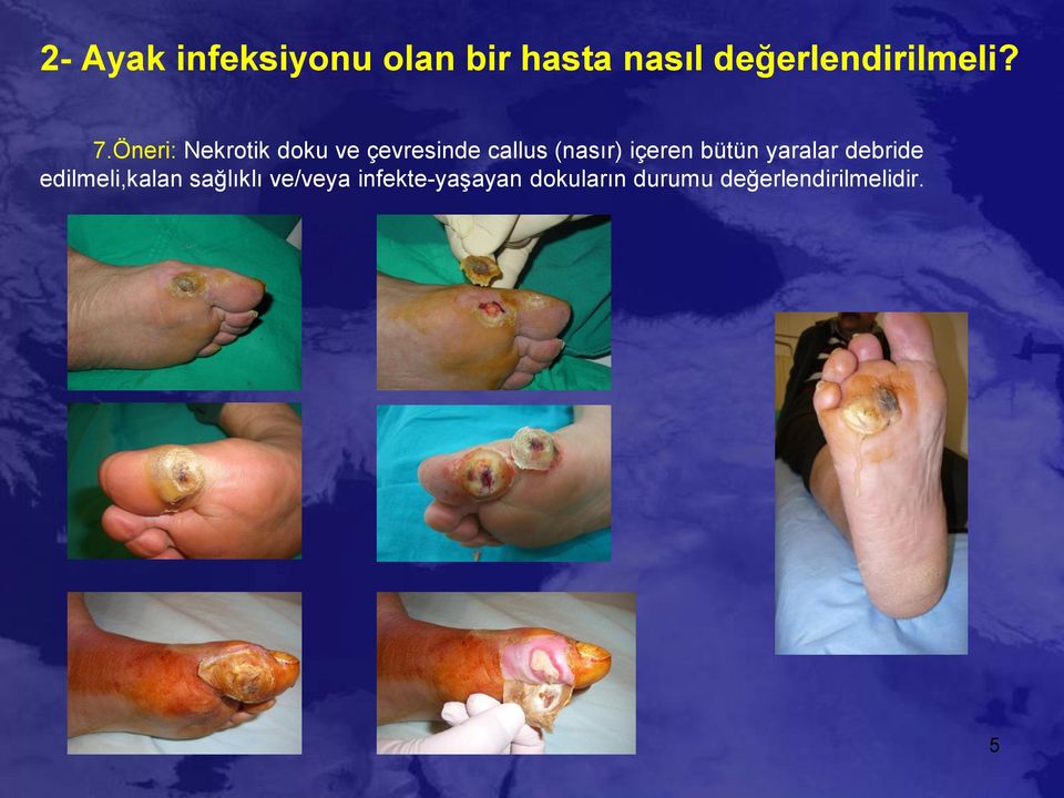 Öneri: Nekrotik doku ve çevresinde callus (nasır) içeren