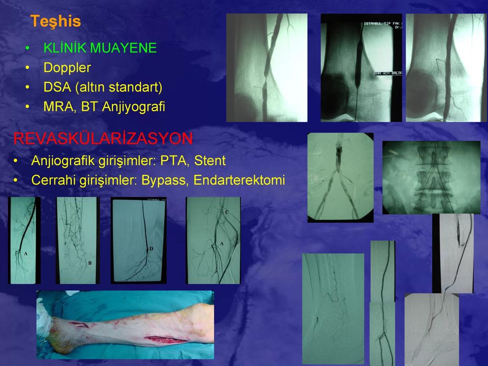 REVASKÜLARİZASYON Anjiografik girişimler: