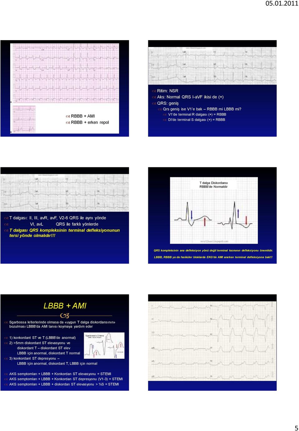 dalgası QRS kompleksinin terminal defleksiyonunun tersi yönde olmalıdır!!! QRS kompleksinin ana defleksiyon yönü değil terminal kısmının defleksiyonu önemlidir.