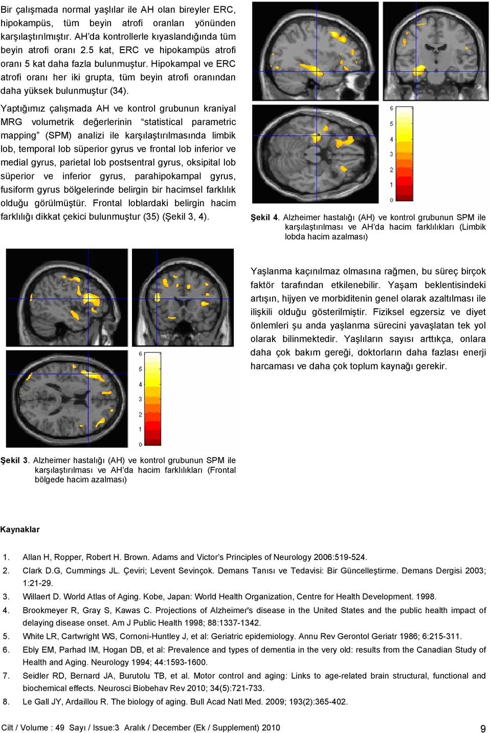 Yaptığımız çalışmada AH ve kontrol grubunun kraniyal MRG volumetrik değerlerinin statistical parametric mapping (SPM) analizi ile karşılaştırılmasında limbik lob, temporal lob süperior gyrus ve