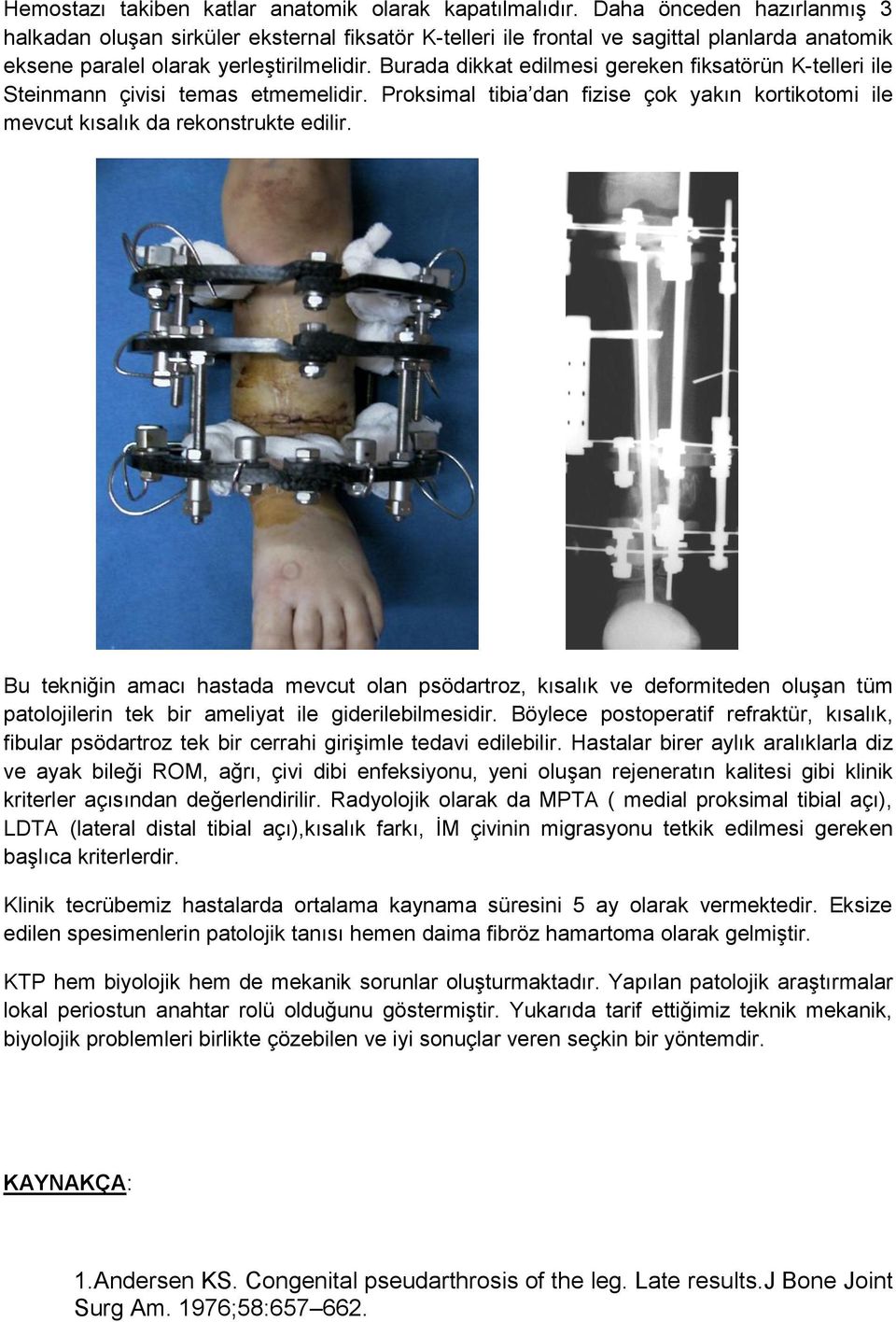 Burada dikkat edilmesi gereken fiksatörün K-telleri ile Steinmann çivisi temas etmemelidir. Proksimal tibia dan fizise çok yakın kortikotomi ile mevcut kısalık da rekonstrukte edilir.