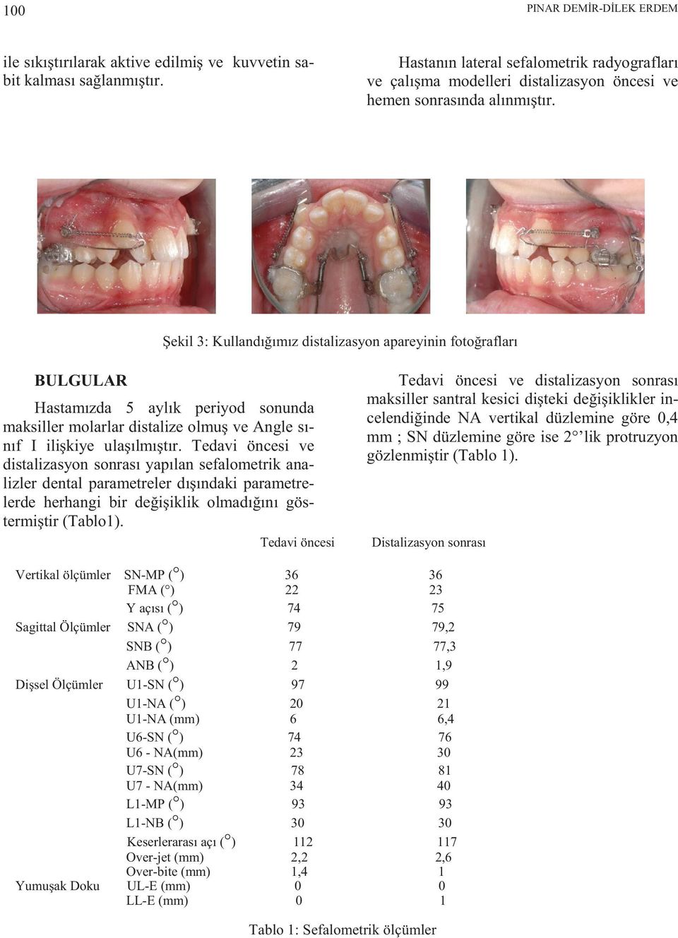 Şekil 3: Kullandığımız distalizasyon apareyinin fotoğrafları BULGULAR Hastamızda 5 aylık periyod sonunda maksiller molarlar distalize olmuş ve Angle sınıf I ilişkiye ulaşılmıştır.