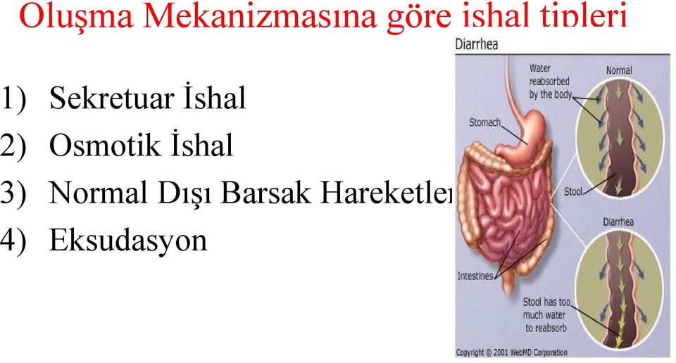 İshal 2) Osmotik İshal 3)