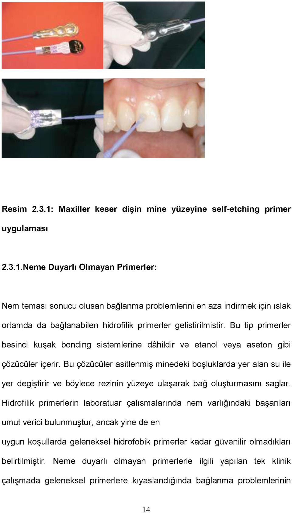 Bu çözücüler asitlenmiş minedeki boşluklarda yer alan su ile yer degiştirir ve böylece rezinin yüzeye ulaşarak bağ oluşturmasını saglar.