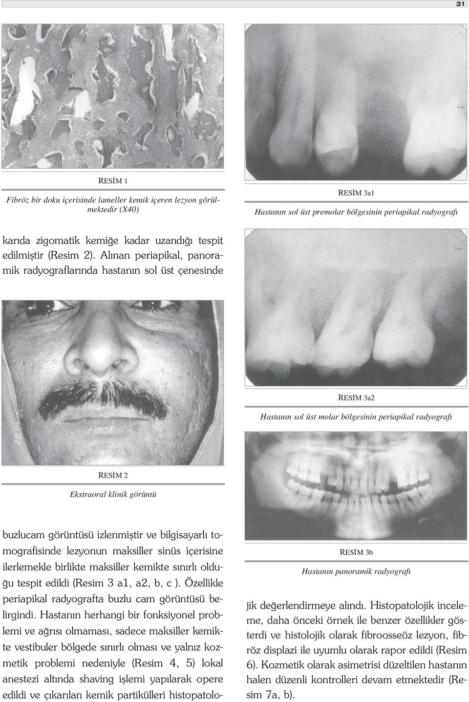 Al nan periapikal, panoramik radyograflar nda hastan n sol üst çenesinde RES M 3a2 Hastan n sol üst molar bölgesinin periapikal radyograf RES M 2 Ekstraoral klinik görüntü buzlucam görüntüsü