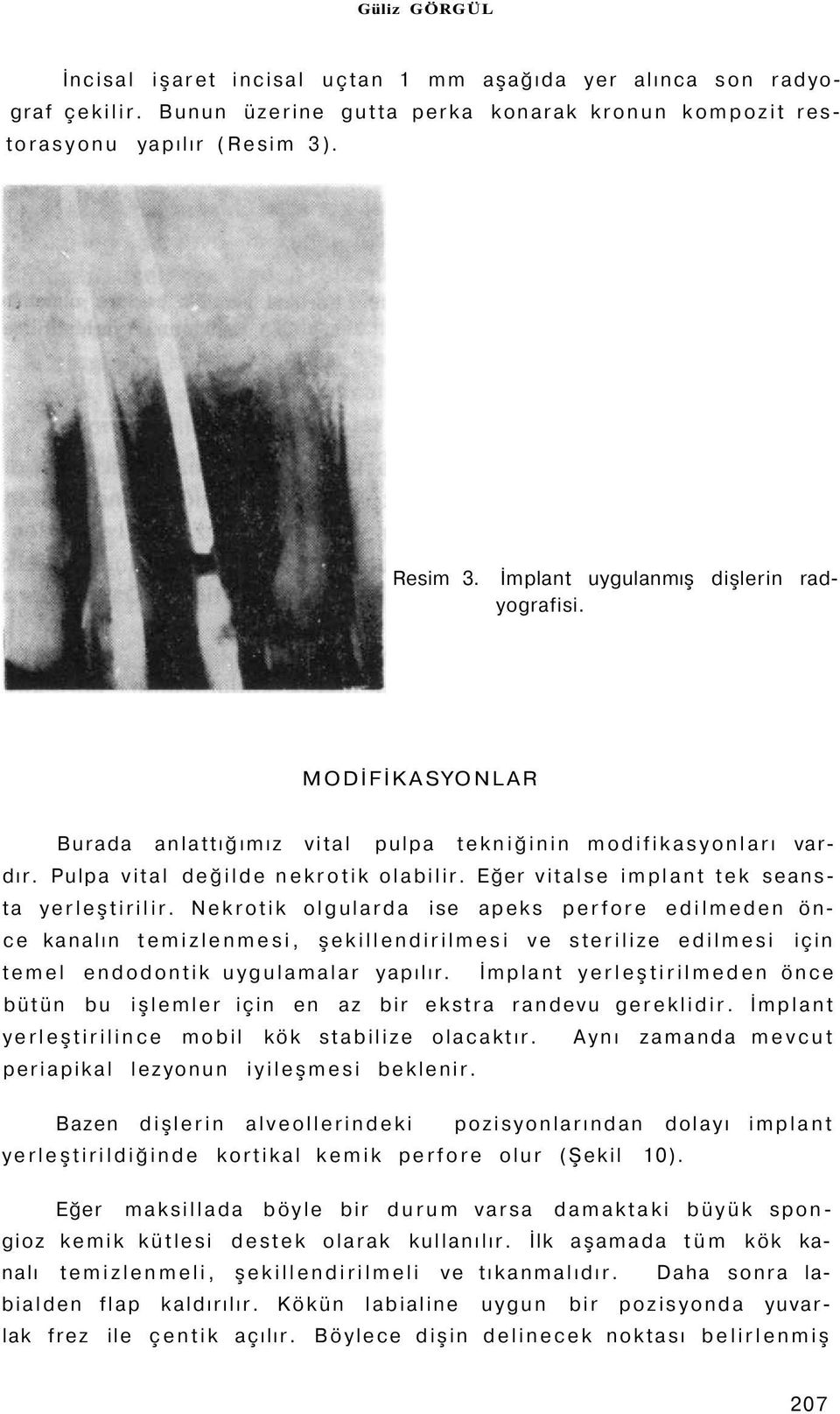 Eğer vitalse implant tek seansta yerleştirilir.