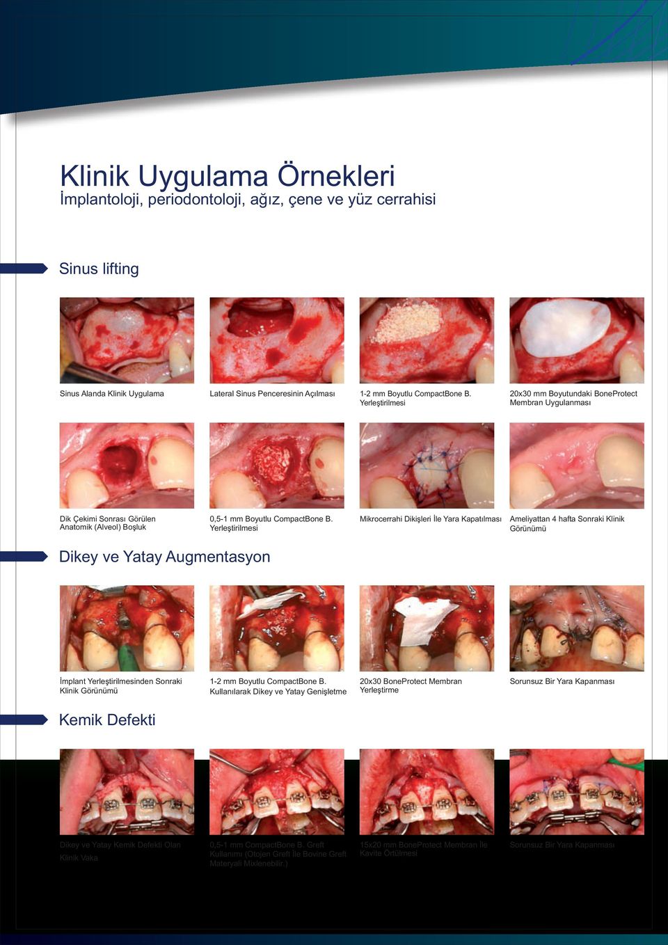 Yerleþtirilmesi Mikrocerrahi Dikiþleri Ýle Yara Kapatýlmasý Ameliyattan 4 hafta Sonraki Klinik Görünümü Dikey ve Yatay Augmentasyon Ýmplant Yerleþtirilmesinden Sonraki Klinik Görünümü 12 mm Boyutlu