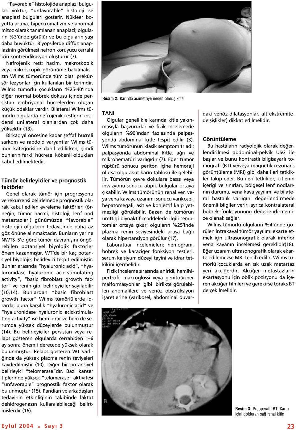 Biyopsilerde diffüz anaplazinin görülmesi nefron koruyucu cerrahi için kontrendikasyon oluflturur (7).