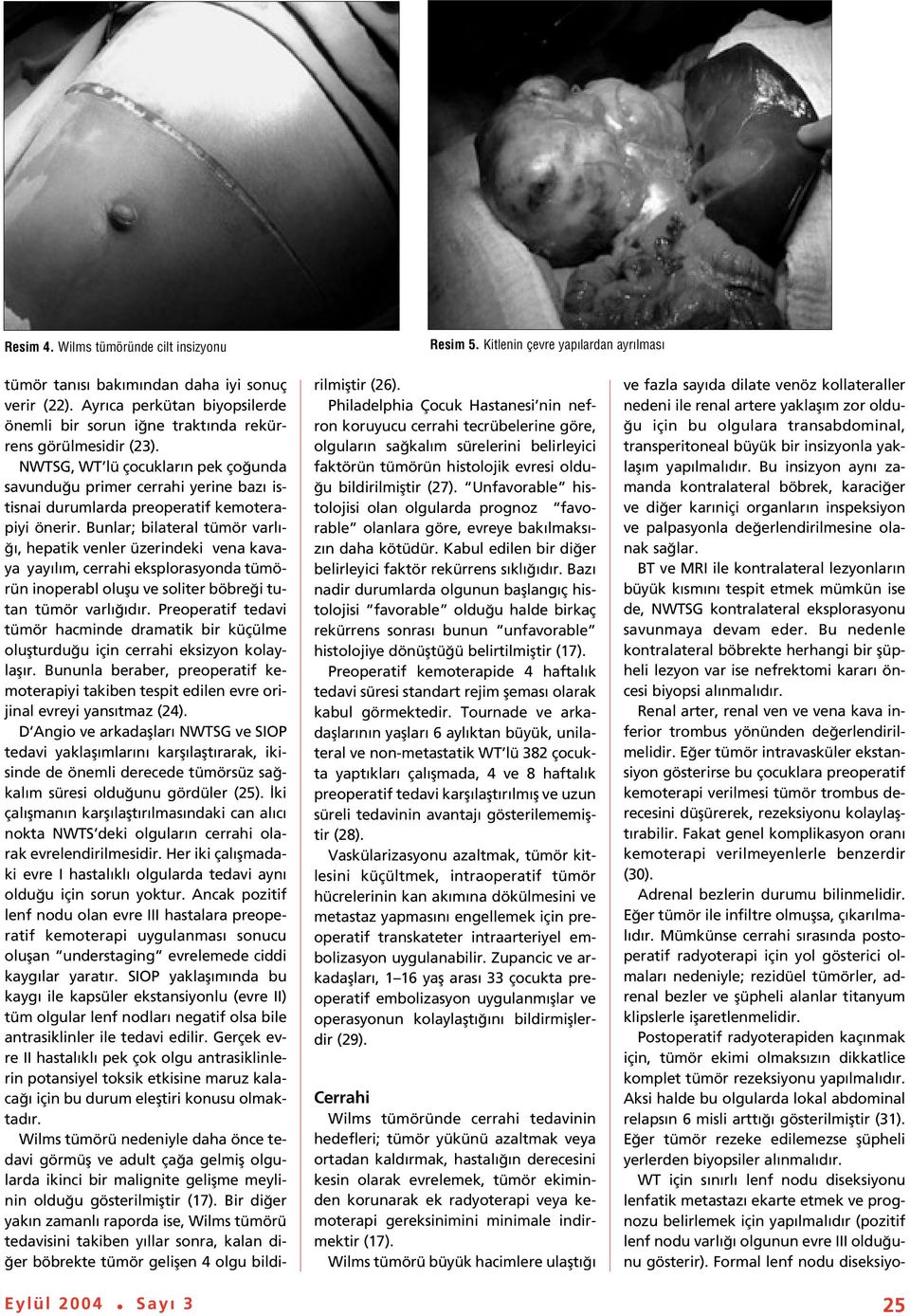 NWTSG, WT lü çocuklar n pek ço unda savundu u primer cerrahi yerine baz istisnai durumlarda preoperatif kemoterapiyi önerir.