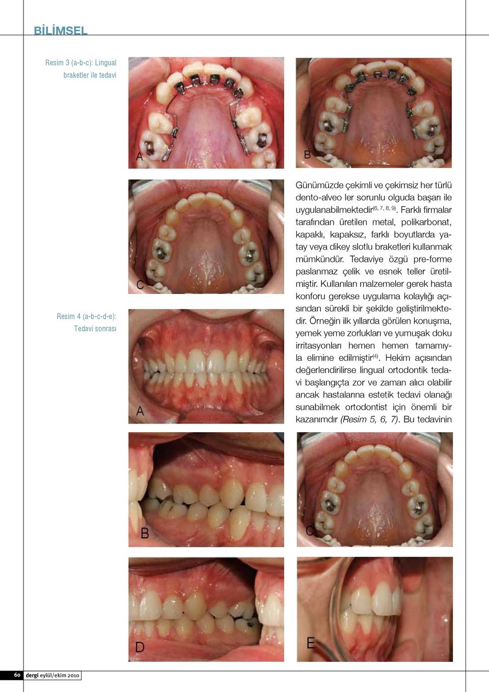 Tedaviye özgü pre-forme paslanmaz çelik ve esnek teller üretilmiştir. Kullanılan malzemeler gerek hasta konforu gerekse uygulama kolaylığı açısından sürekli bir şekilde geliştirilmektedir.