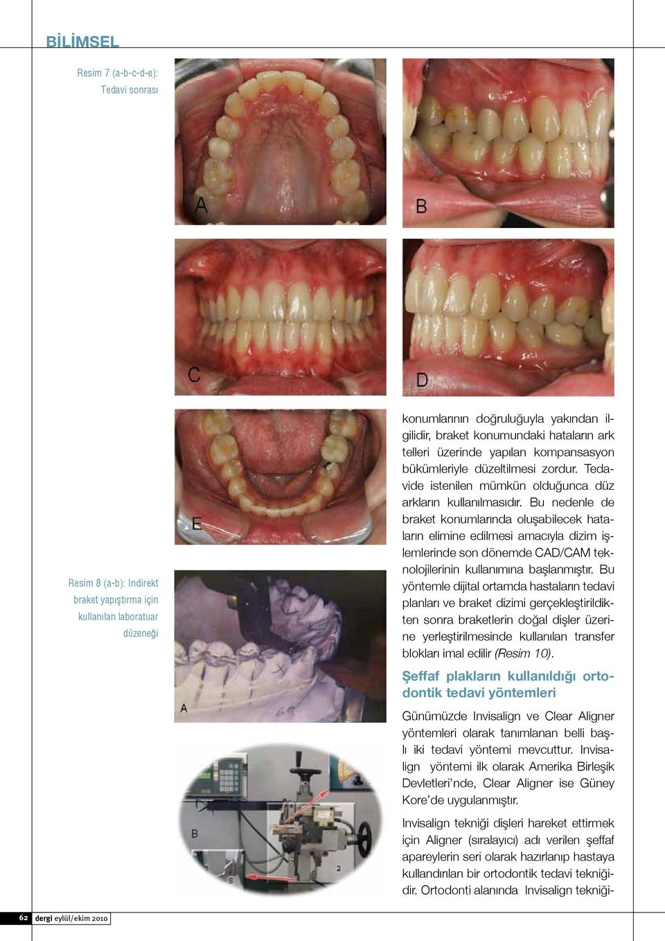 Bu nedenle de braket konumlarında oluşabilecek hataların elimine edilmesi amacıyla dizim işlemlerinde son dönemde CAD/CAM teknolojilerinin kullanımına başlanmıştır.