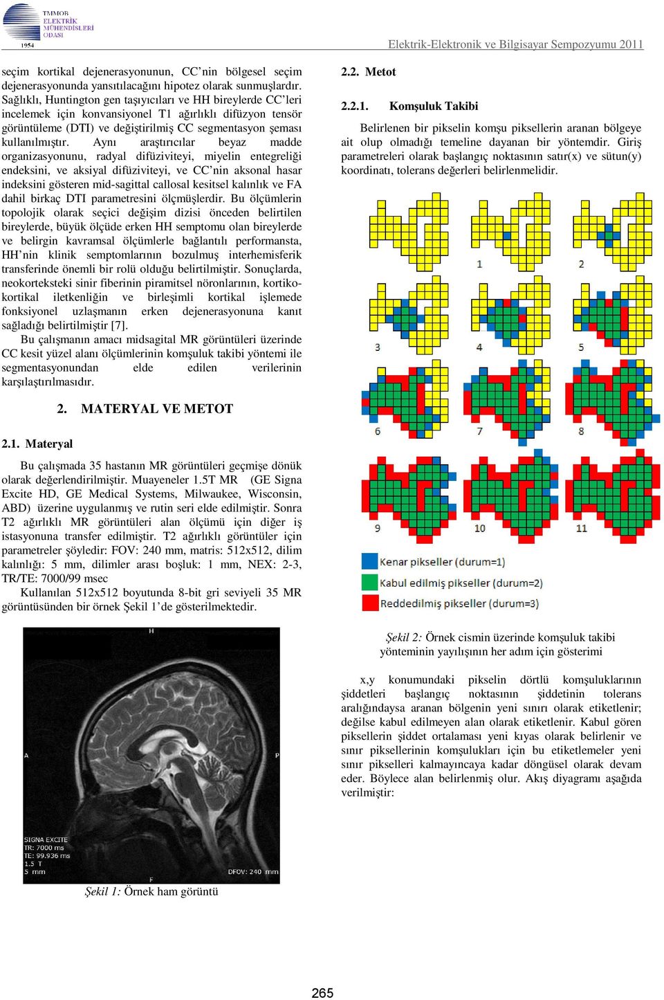 Aynı araştırıcılar beyaz madde organizasyonunu, radyal difüziviteyi, miyelin entegreliği endeksini, ve aksiyal difüziviteyi, ve CC nin aksonal hasar indeksini gösteren mid-sagittal callosal kesitsel