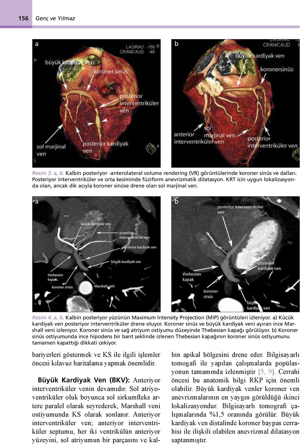 Kalbin posteriyor yüzünün Maximum Intensity Projection (MIP) görüntüleri izleniyor. a) Küçük kardiyak ven posteriyor interventriküler drene oluyor.