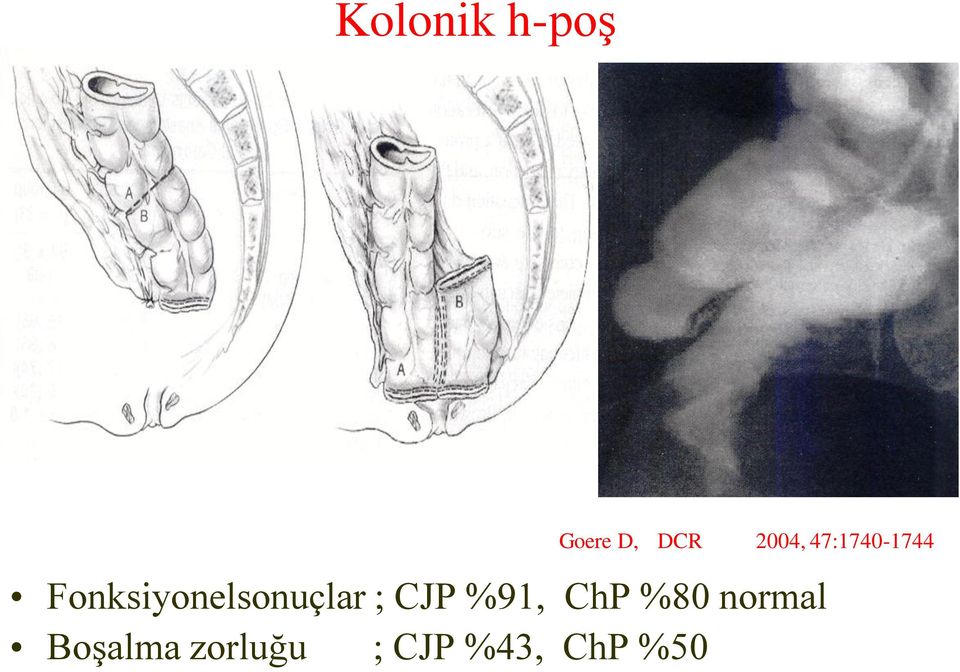 Fonksiyonelsonuçlar ; CJP %91,