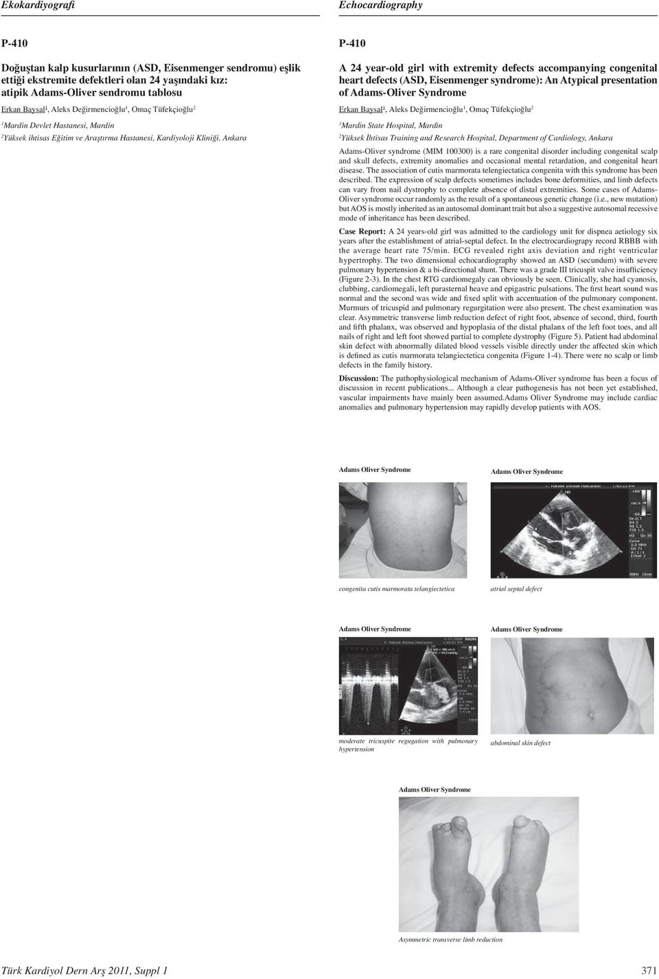 (ASD, Eisenmenger syndrome): An Atypical presentation of Adams-Oliver Syndrome Erkan Baysal, Aleks Değirmencioğlu, Omaç Tüfekçioğlu Mardin State Hospital, Mardin Yüksek İhtisas Training and Research