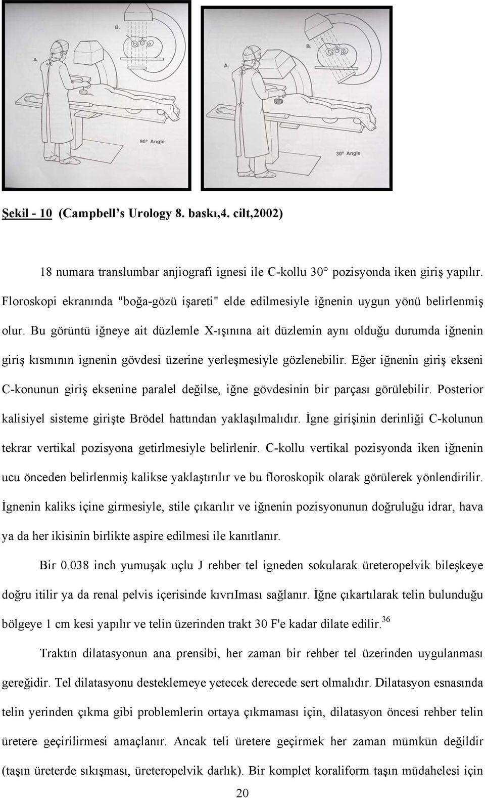 Bu görüntü iğneye ait düzlemle X-ışınına ait düzlemin aynı olduğu durumda iğnenin giriş kısmının ignenin gövdesi üzerine yerleşmesiyle gözlenebilir.