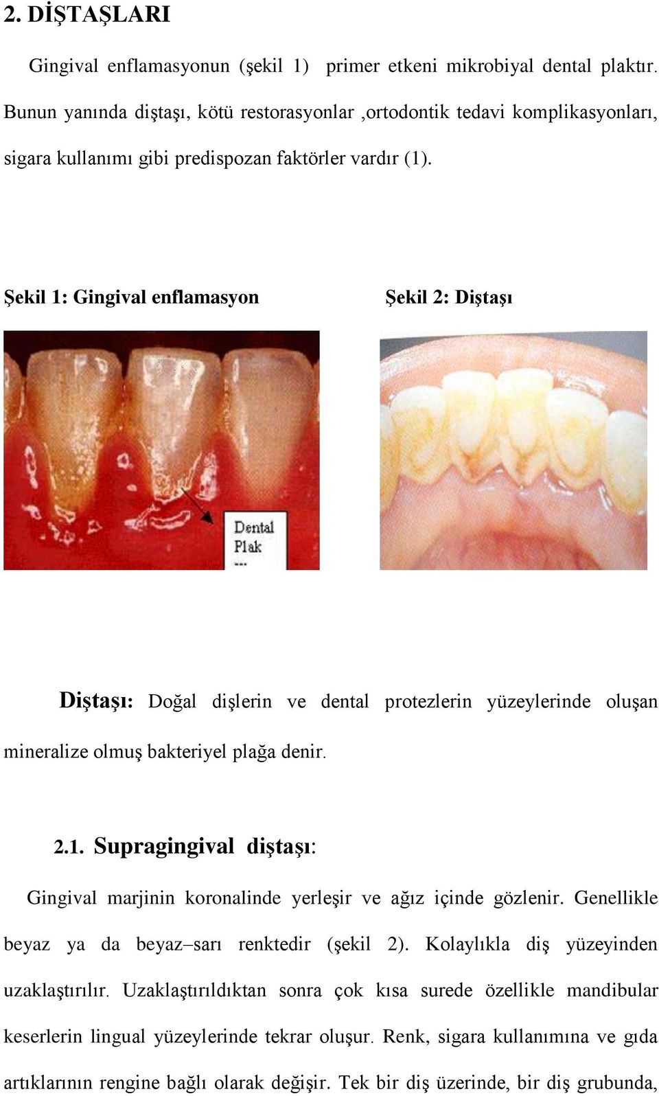 Şekil 1: Gingival enflamasyon Şekil 2: Diştaşı Diştaşı: Doğal dişlerin ve dental protezlerin yüzeylerinde oluşan mineralize olmuş bakteriyel plağa denir. 2.1. Supragingival diştaşı: Gingival marjinin koronalinde yerleşir ve ağız içinde gözlenir.