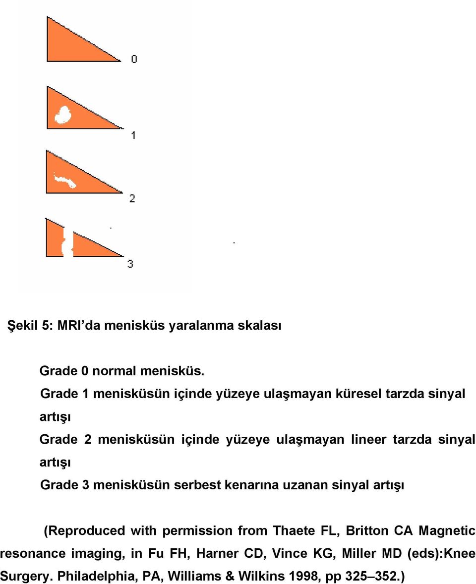 lineer tarzda sinyal artışı Grade 3 menisküsün serbest kenarına uzanan sinyal artışı (Reproduced with permission from