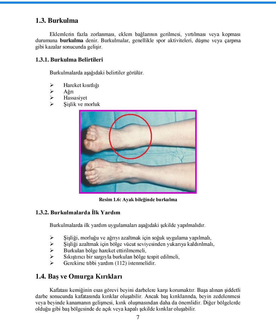 Hareket kısıtlığı Ağrı Hassasiyet ġiģlik ve morluk 1.3.2. Burkulmalarda Ġlk Yardım Resim 1.6: Ayak bileğinde burkulma Burkulmalarda ilk yardım uygulamaları aģağıdaki Ģekilde yapılmalıdır.