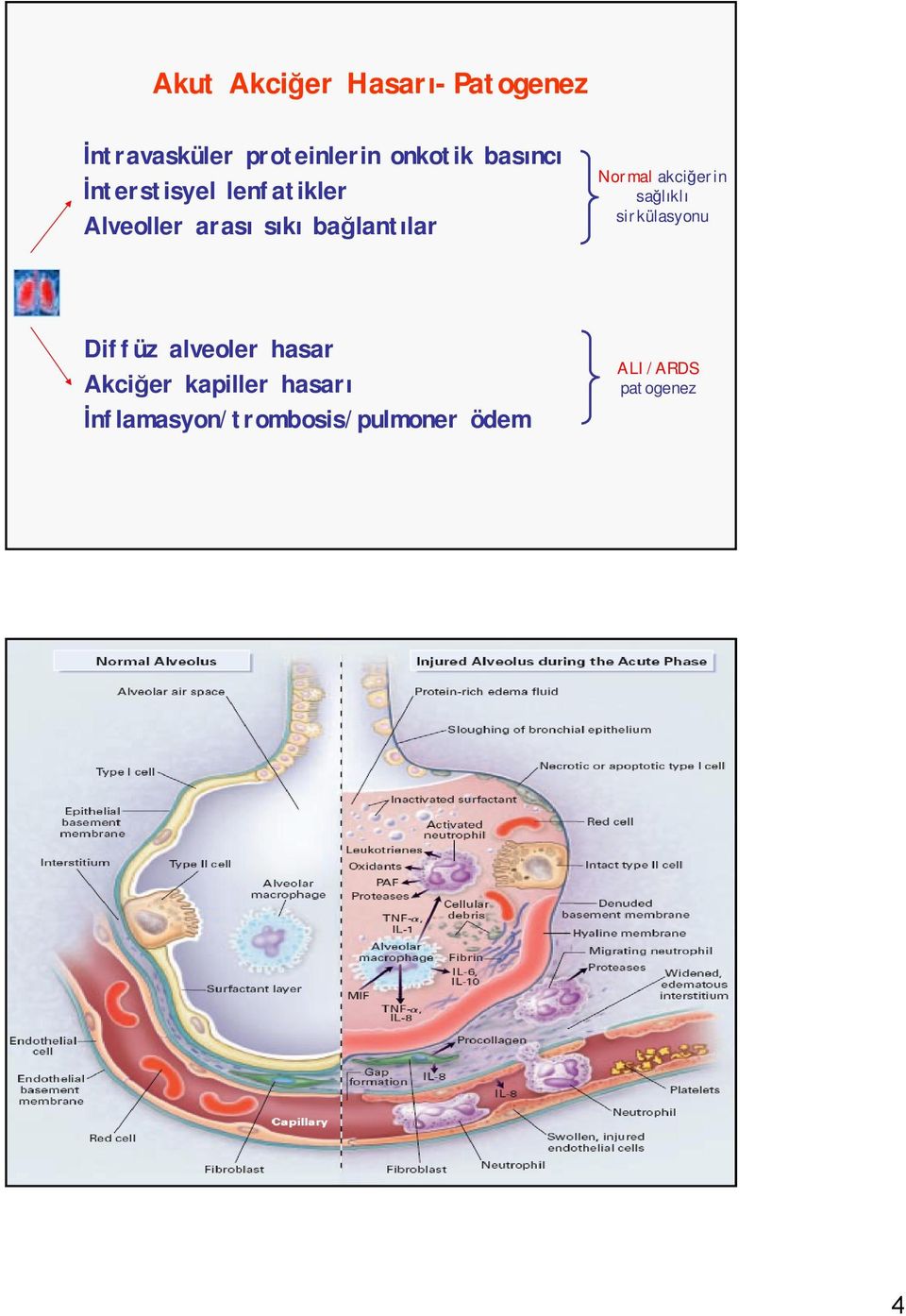 Normal akciğerin sağlıklı sirkülasyonu Diffüz alveoler hasar