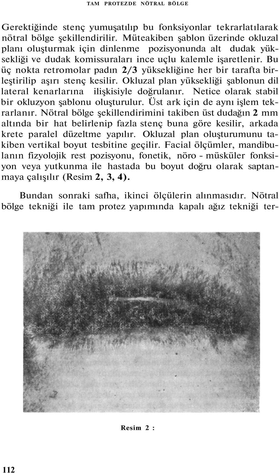 Bu üç nokta retromolar padın 2/3 yüksekliğine her bir tarafta birleştirilip aşırı stenç kesilir. Okluzal plan yüksekliği şablonun dil lateral kenarlarına ilişkisiyle doğrulanır.