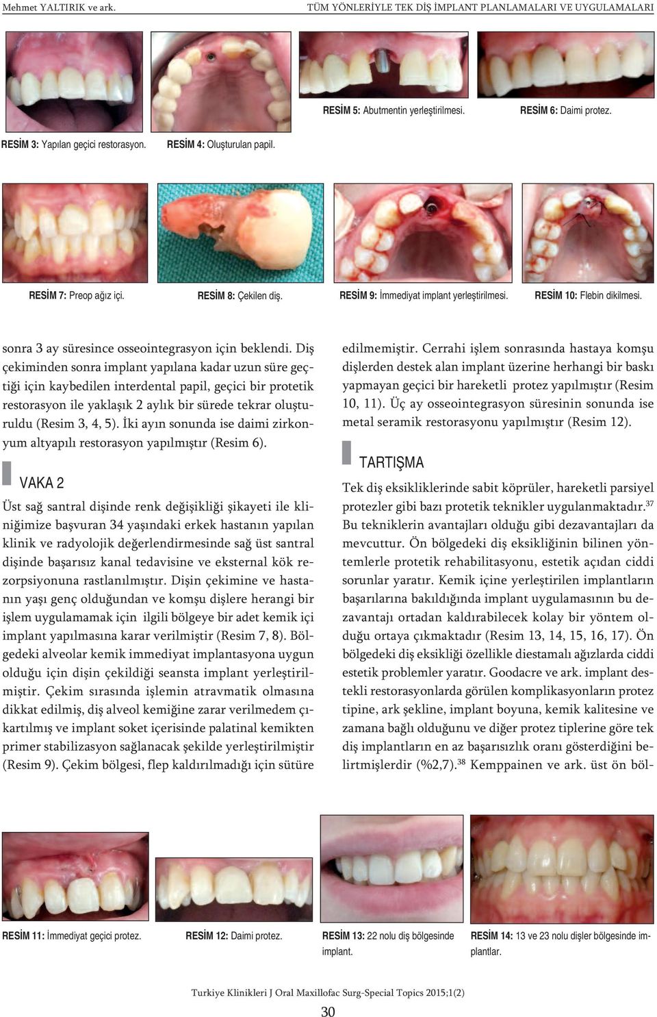 Diş çekiminden sonra implant yapılana kadar uzun süre geçtiği için kaybedilen interdental papil, geçici bir protetik restorasyon ile yaklaşık 2 aylık bir sürede tekrar oluşturuldu (Resim 3, 4, 5).