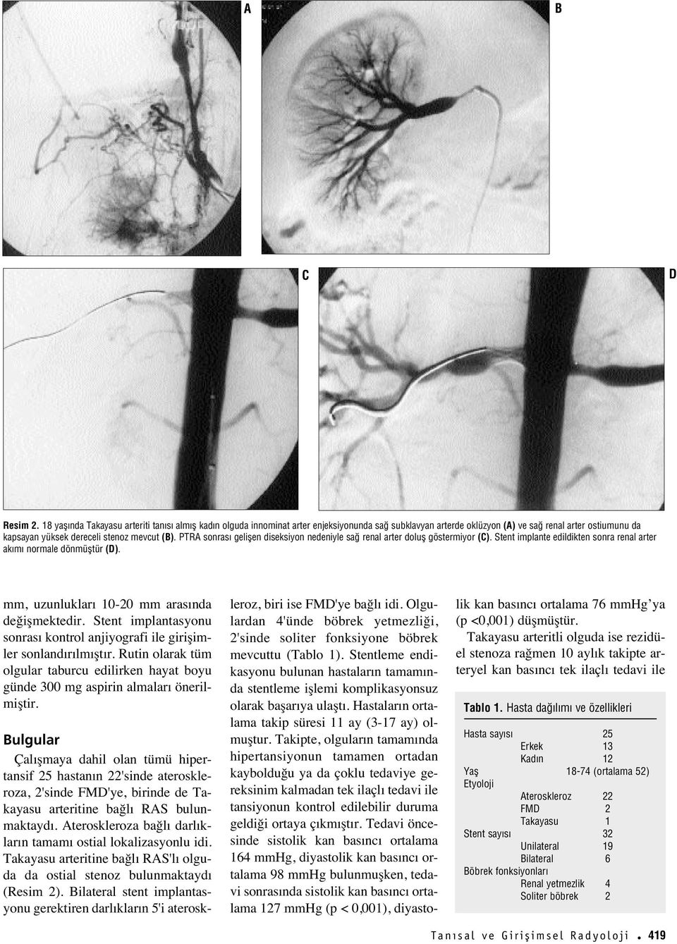 PTRA sonras geliflen diseksiyon nedeniyle sa renal arter dolufl göstermiyor (C). Stent implante edildikten sonra renal arter ak m normale dönmüfltür (D).