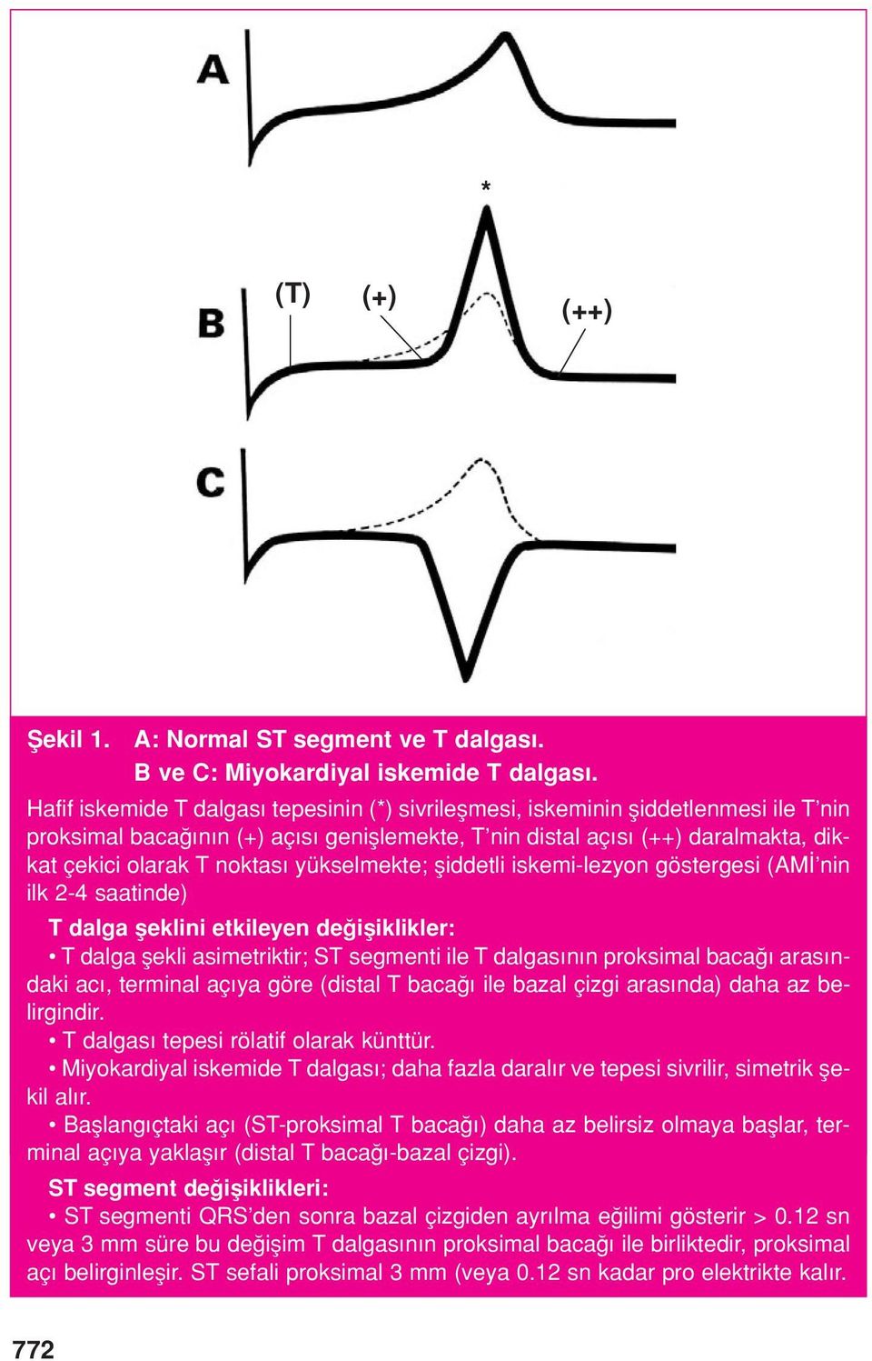 yükselmekte; fliddetli iskemi-lezyon göstergesi (AM nin ilk 2-4 saatinde) T dalga fleklini etkileyen de ifliklikler: T dalga flekli asimetriktir; ST segmenti ile T dalgas n n proksimal baca aras