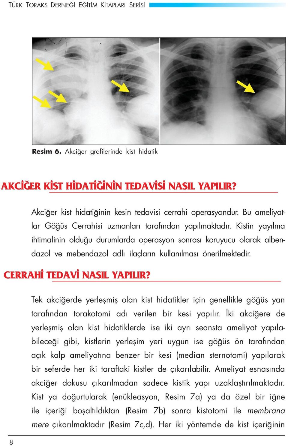 Kistin yayılma ihtimalinin olduğu durumlarda operasyon sonrası koruyucu olarak albendazol ve mebendazol adlı ilaçların kullanılması önerilmektedir. CERRAHİ TEDAVİ NASIL YAPILIR?