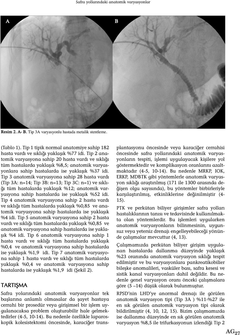 Tip 3 anatomik varyasyona sahip 28 hasta vardı (Tip 3: n=14; Tip 3: n=13; Tip 3C: n=1) ve sıklığı tüm hastalarda yaklaşık %12; anatomik varyasyona sahip hastalarda ise yaklaşık %52 idi.