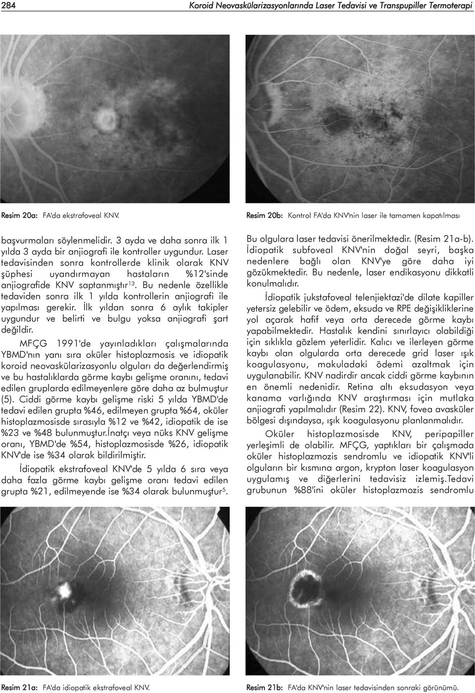 Laser tedavisinden sonra kontrollerde klinik olarak KNV þüphesi uyandýrmayan hastalarýn %12'sinde anjiografide KNV saptanmýþtýr 13.