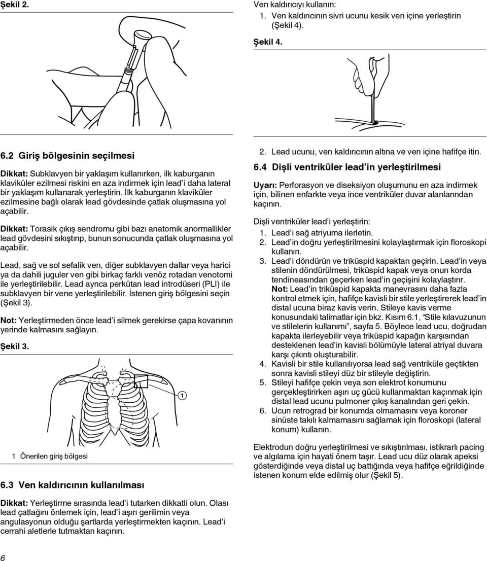 İlk kaburganın klaviküler ezilmesine bağlı olarak lead gövdesinde çatlak oluşmasına yol açabilir.