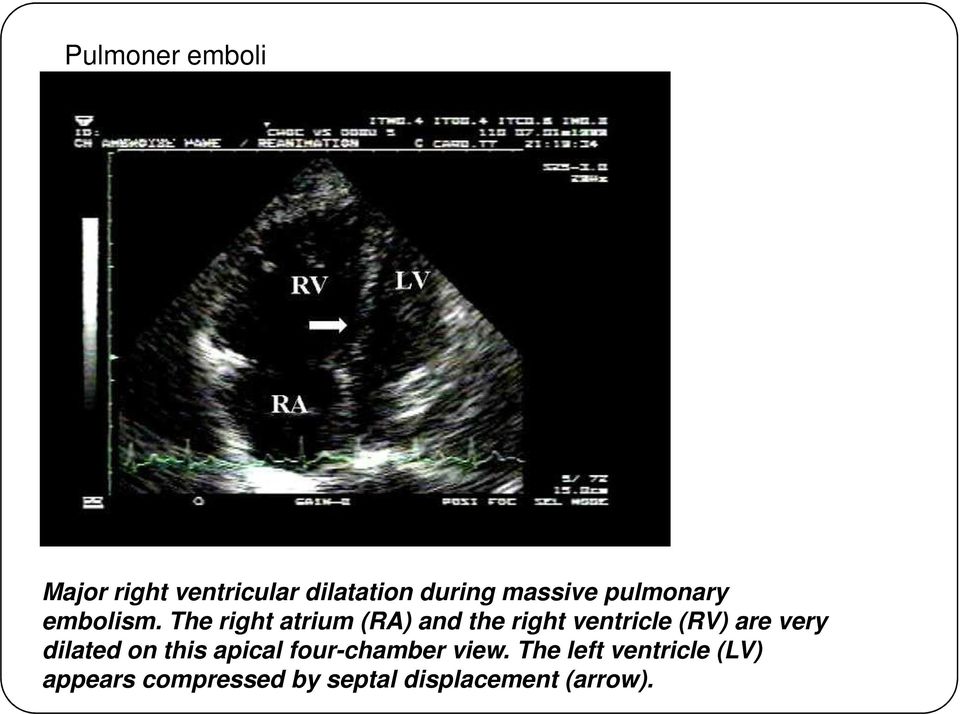 The right atrium (RA) and the right ventricle (RV) are very