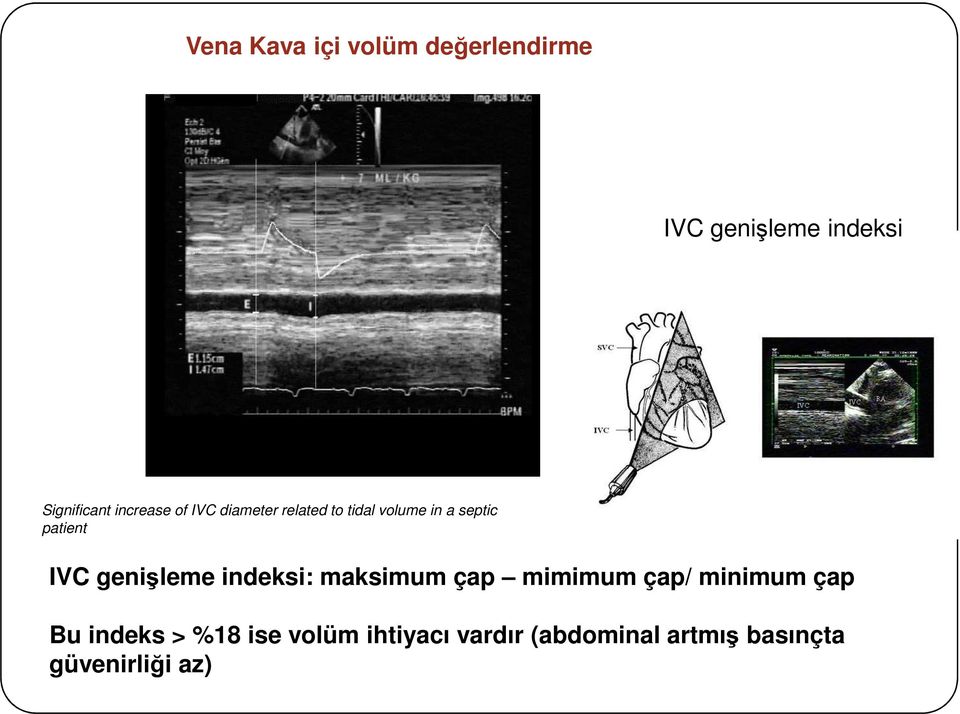 IVC genişleme indeksi: maksimum çap mimimum çap/ minimum çap Bu indeks