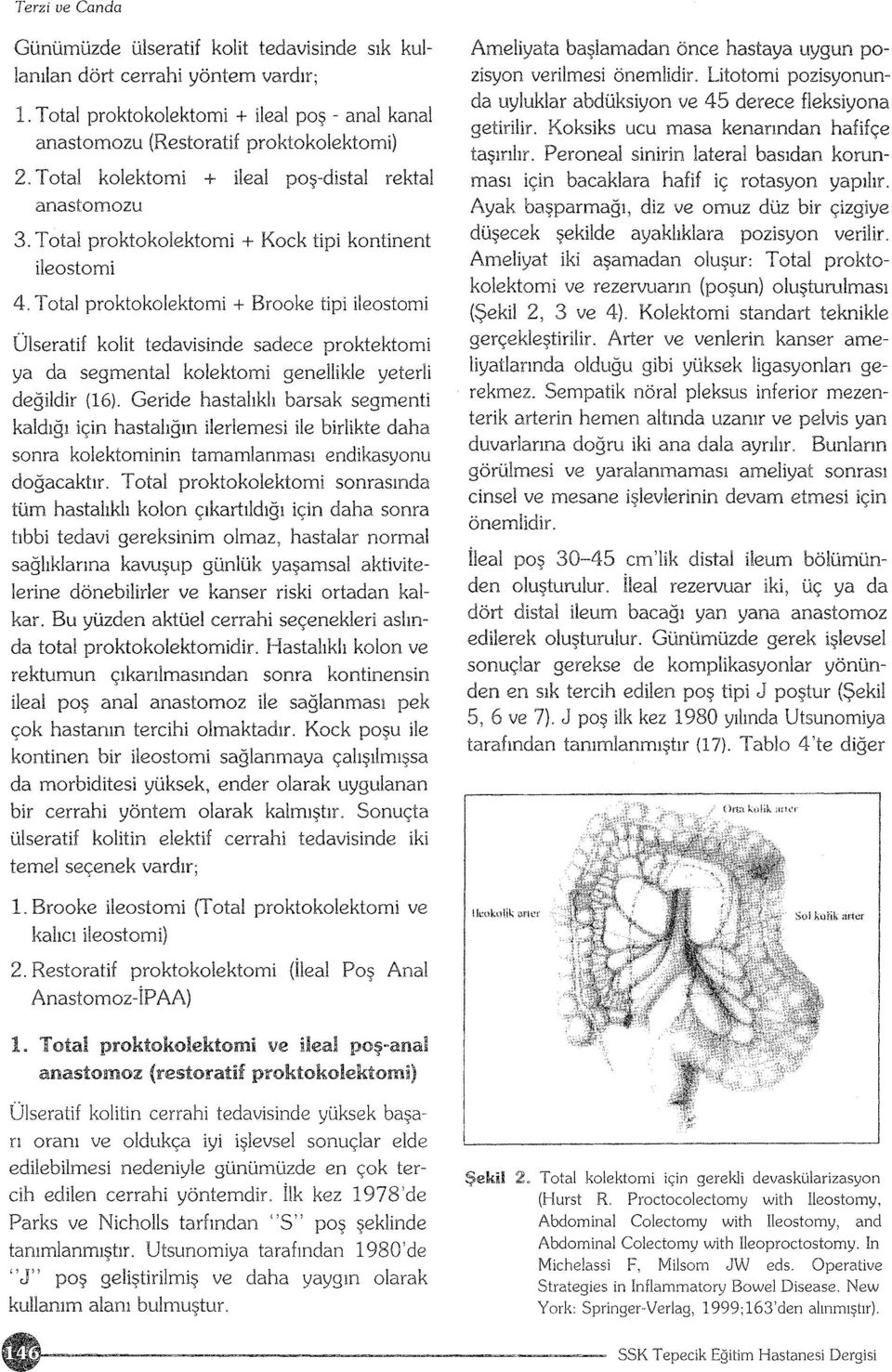 Total proktokolektomi + Brooke tipi ileostomi Ülseratif kolit tedavisinde sadece proktektomi ya da segmental kolektomi genellikle yeterli değildir (16)0 Geride hastalıklı barsak segmenti kaldığı için