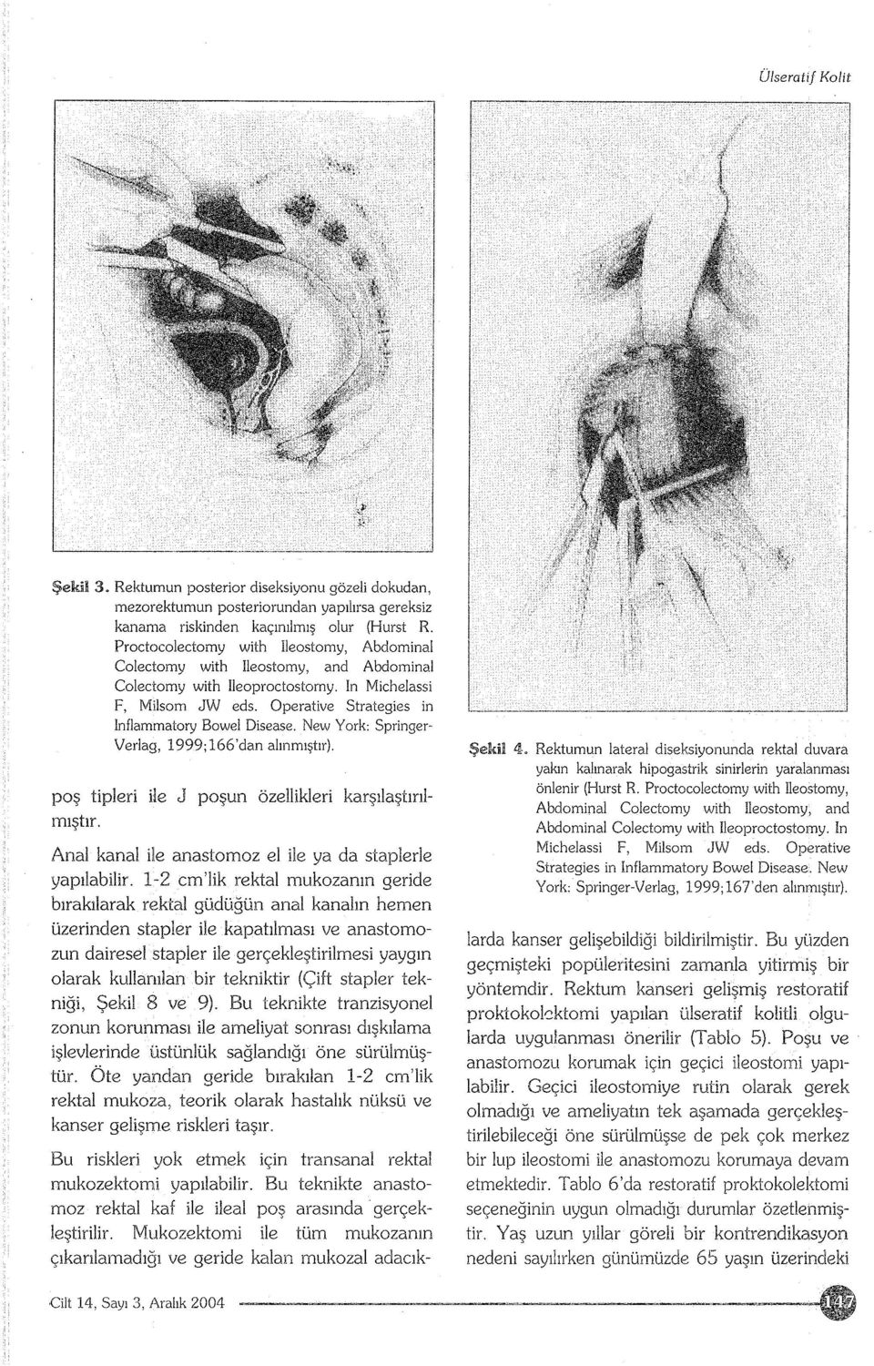 New York: Springer Verlag, 1999;166'dan alınmıştır). poş tipleri ile J poşun özellikleri karşılaştırılmıştır. Anal kanal ile anastomoz el ile ya da staplerle yapılabilir.