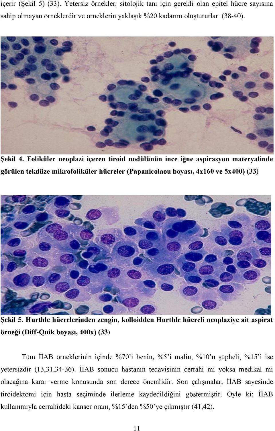 Hurthle hücrelerinden zengin, kolloidden Hurthle hücreli neoplaziye ait aspirat örneği (Diff-Quik boyası, 400x) (33) Tüm ĠĠAB örneklerinin içinde %70 i benin, %5 i malin, %10 u Ģüpheli, %15 i ise