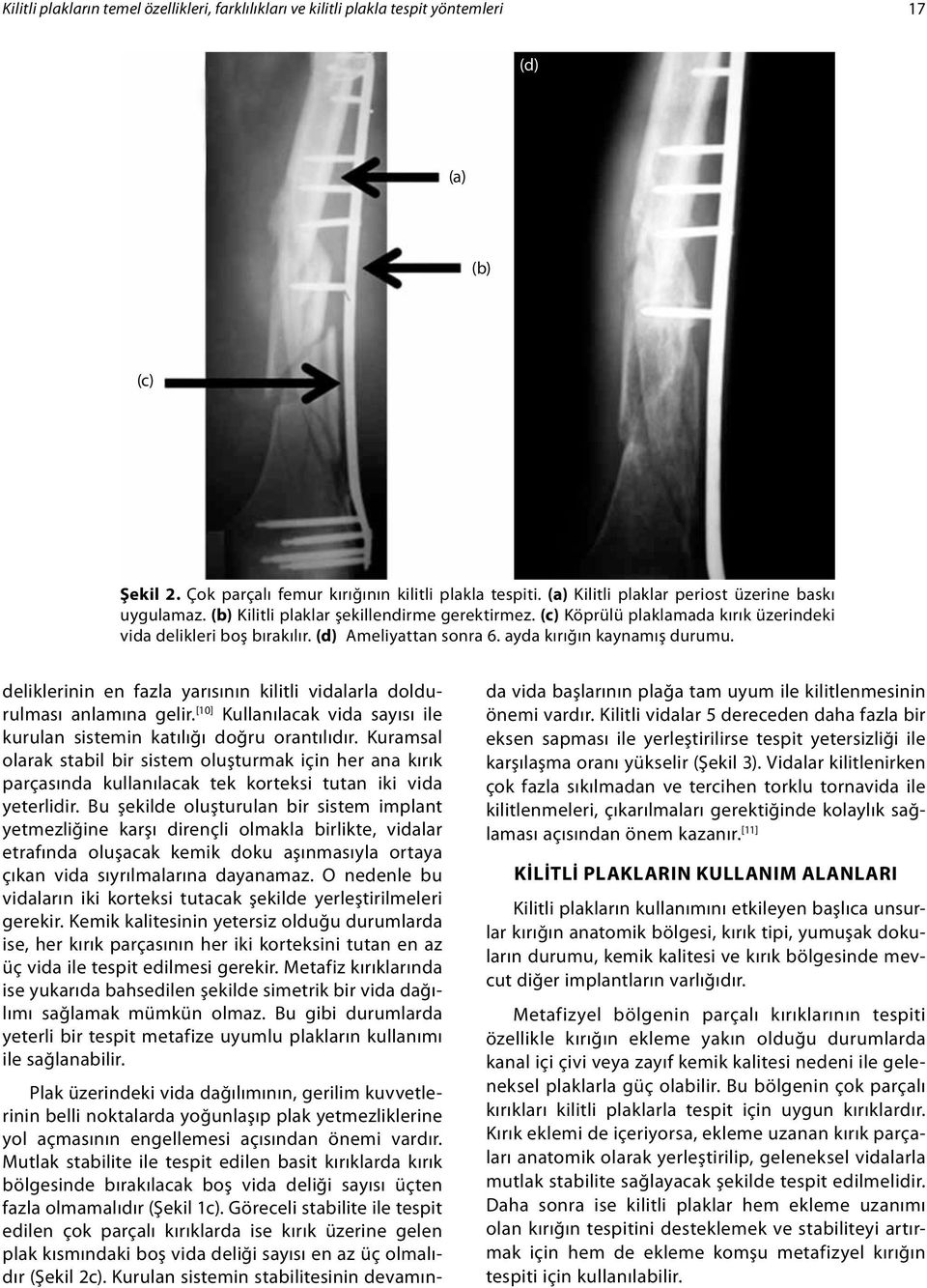 ayda kırığın kaynamış durumu. deliklerinin en fazla yarısının kilitli vidalarla doldurulması anlamına gelir. [10] Kullanılacak vida sayısı ile kurulan sistemin katılığı doğru orantılıdır.