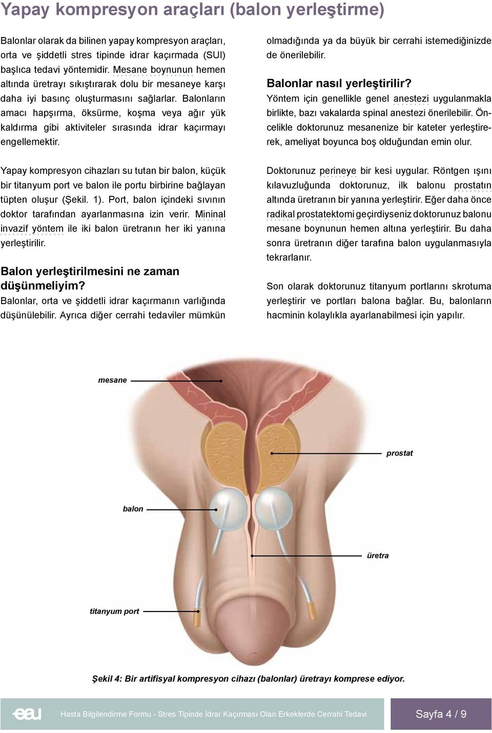 Balonların amacı hapşırma, öksürme, koşma veya ağır yük kaldırma gibi aktiviteler sırasında idrar kaçırmayı engellemektir. olmadığında ya da büyük bir cerrahi istemediğinizde de önerilebilir.