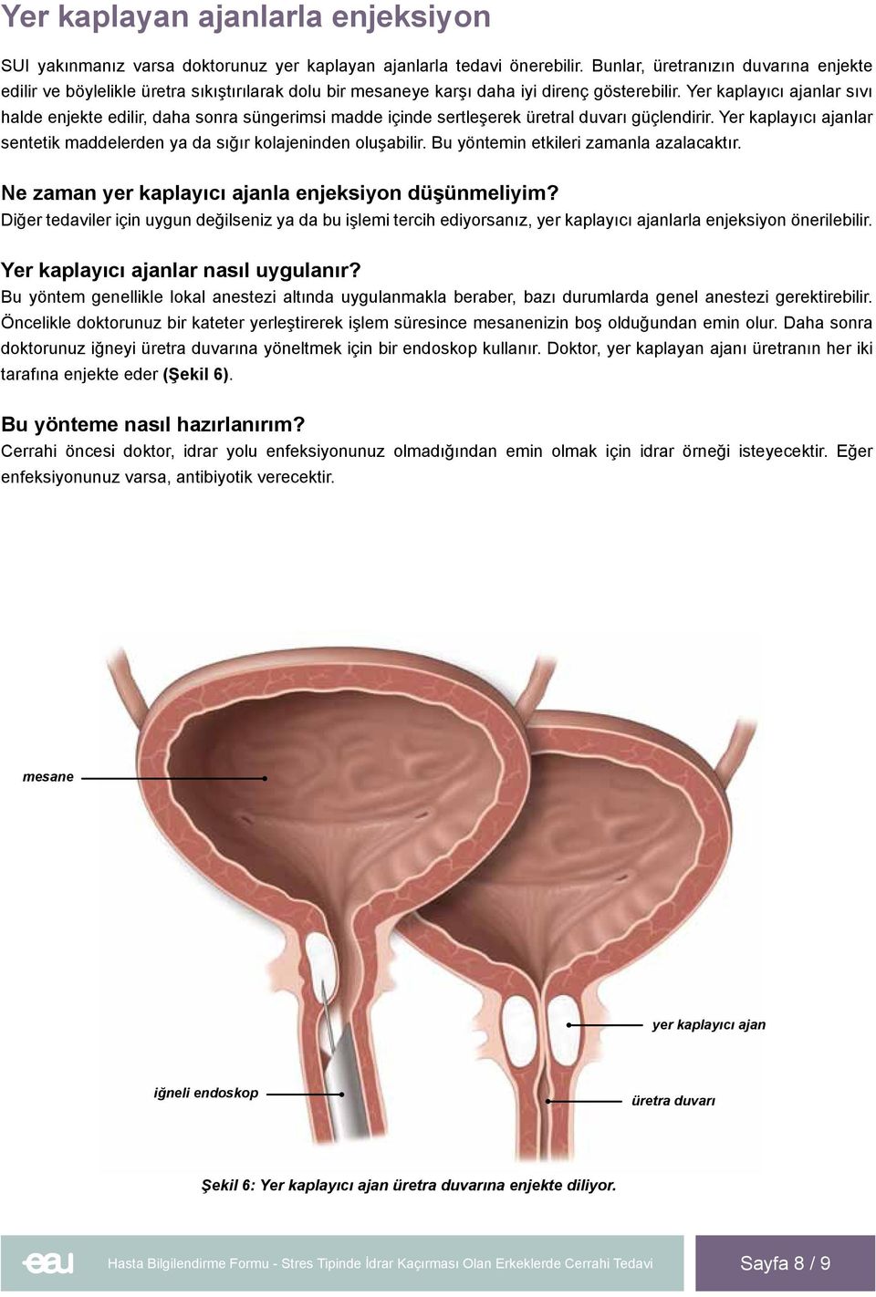 Yer kaplayıcı ajanlar sıvı halde enjekte edilir, daha sonra süngerimsi madde içinde sertleşerek üretral duvarı güçlendirir.