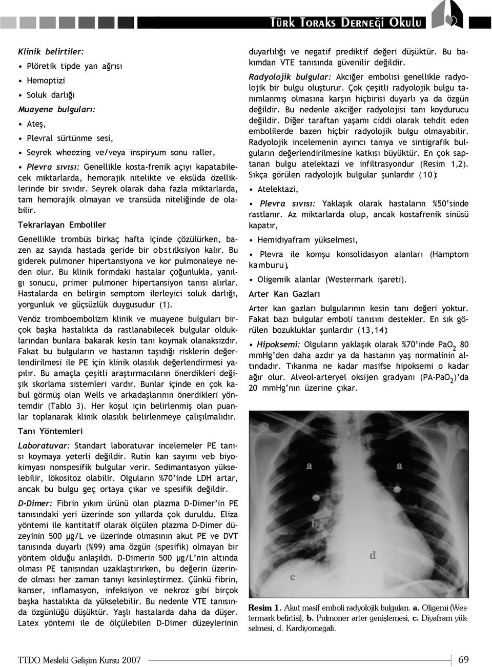 Tekrarlayan Emboliler Genellikle trombüs birkaç hafta içinde çözülürken, bazen az say da hastada geride bir o b s t rüksiyon kal r. Bu giderek pulmoner hipertansiyona ve kor pulmonaleye neden olur.