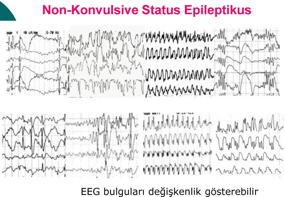 Epileptikus EEG