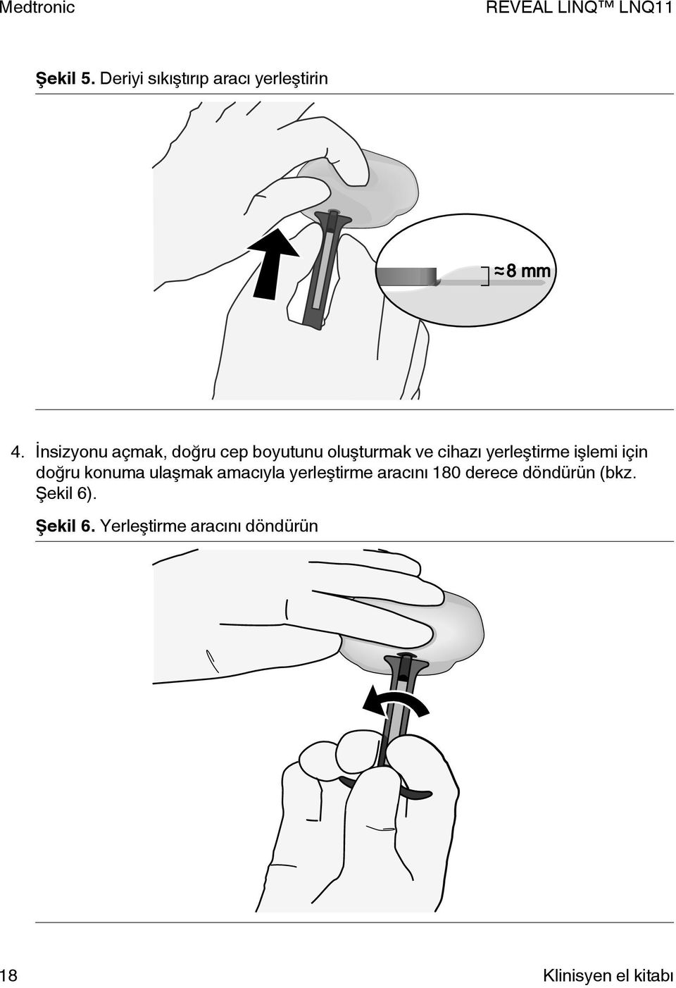 işlemi için doğru konuma ulaşmak amacıyla yerleştirme aracını 180