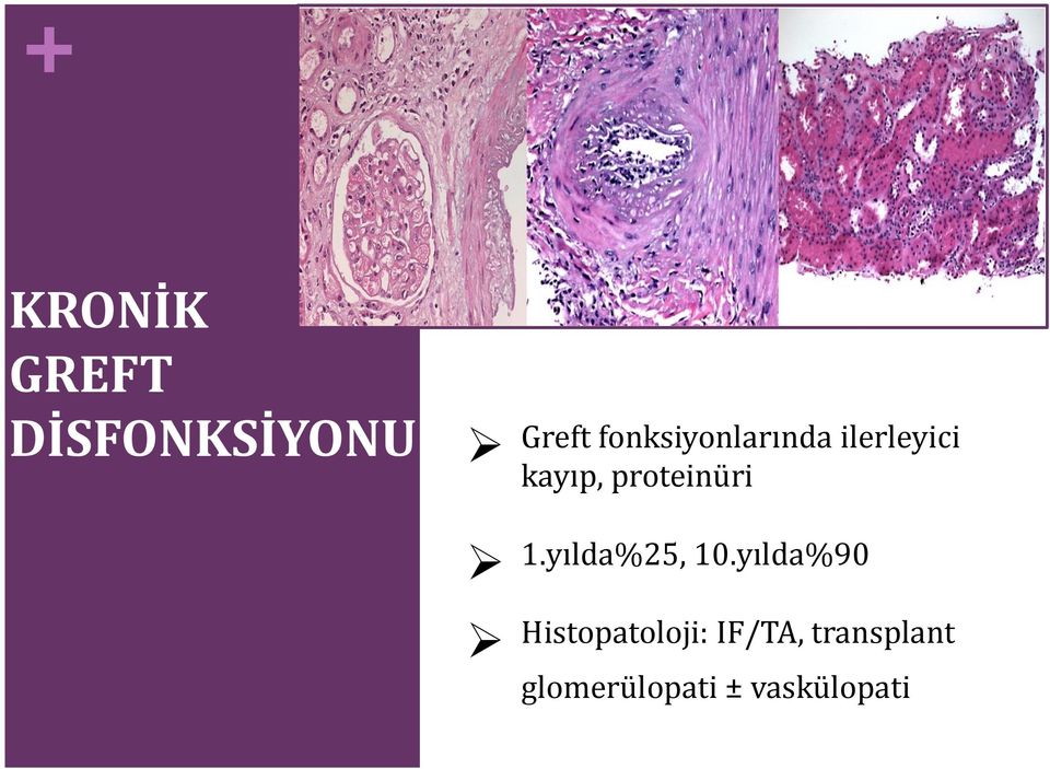 proteinüri 1.yılda%25, 10.