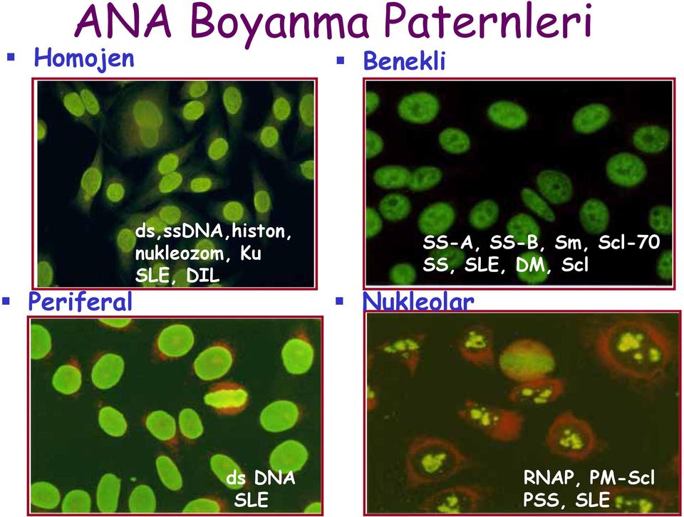 SLE, DIL Nukleolar SS-A, SS-B, Sm, Scl-70
