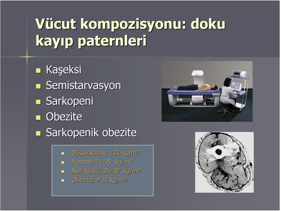 Sarkopenik obezite Düşük k kilolu; <21 kg/m²