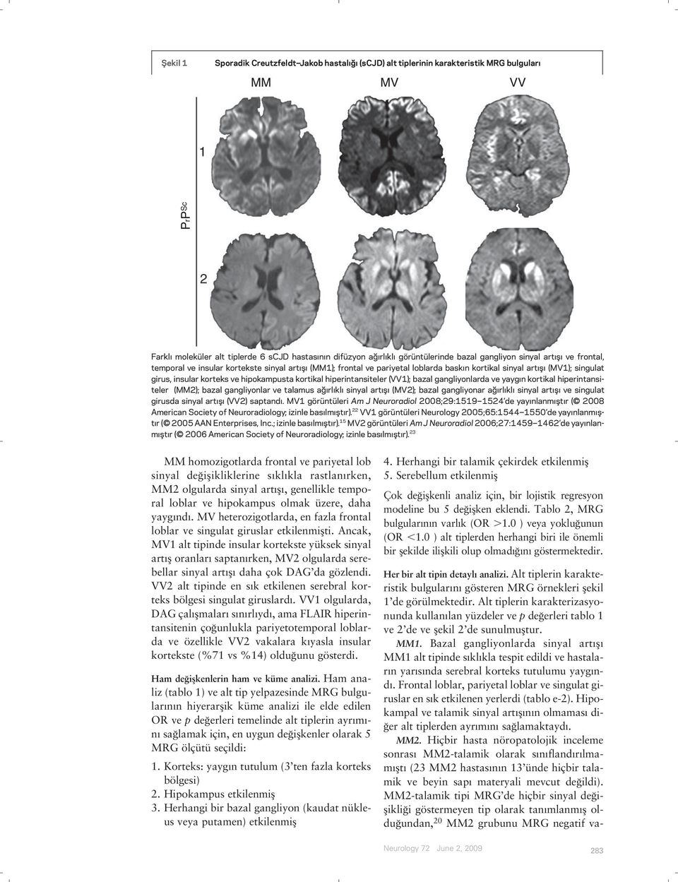 hipokampusta kortikal hiperintansiteler (VV1); bazal gangliyonlarda ve yaygın kortikal hiperintansiteler (MM2); bazal gangliyonlar ve talamus ağırlıklı sinyal artışı (MV2); bazal gangliyonar