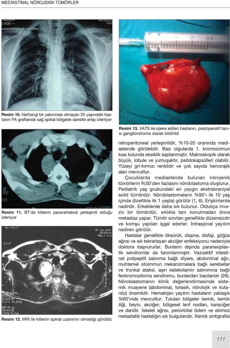 MRI ile kitlenin spinal uzanımın olmadığı görüldü retroperitoneal yerleşimlidir, %10-20 oranında mediastende görülebilir. Bazı olgularda 1. kromozomun kısa kolunda eksiklik saptanmıştır.