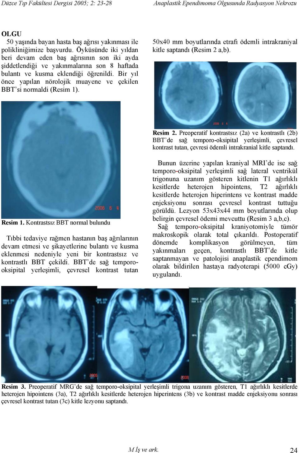Bir yıl önce yapılan nörolojik muayene ve çekilen BBT si normaldi (Resim 1). 50x40 mm boyutlarında etrafı ödemli intrakraniyal kitle saptandı (Resim 2 a,b). Resim 2.
