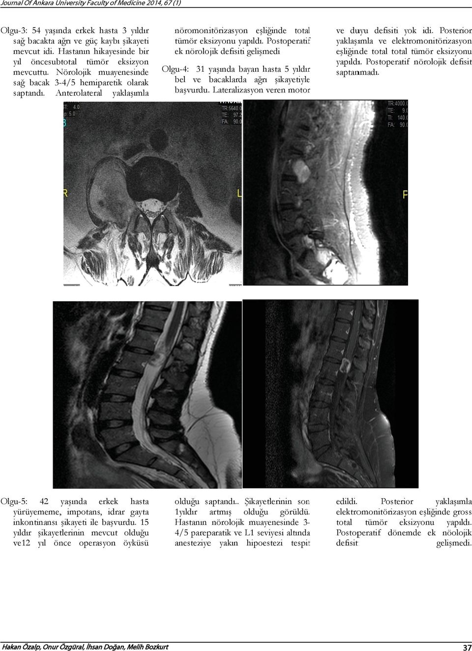 Anterolateral yaklaşımla nöromonitörizasyon eşliğinde totall tümör eksizyonu yapıldı.